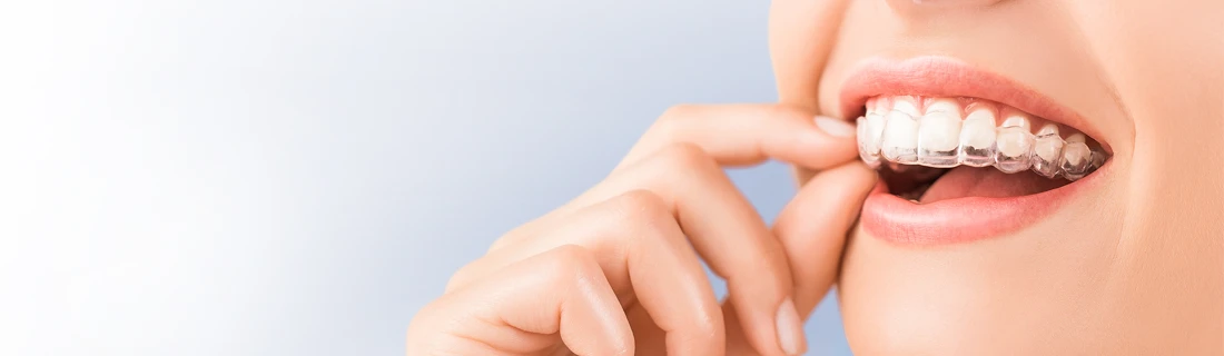 Clear Aligners in Granada Hills CA Clear Aligners in Granada Hills CA